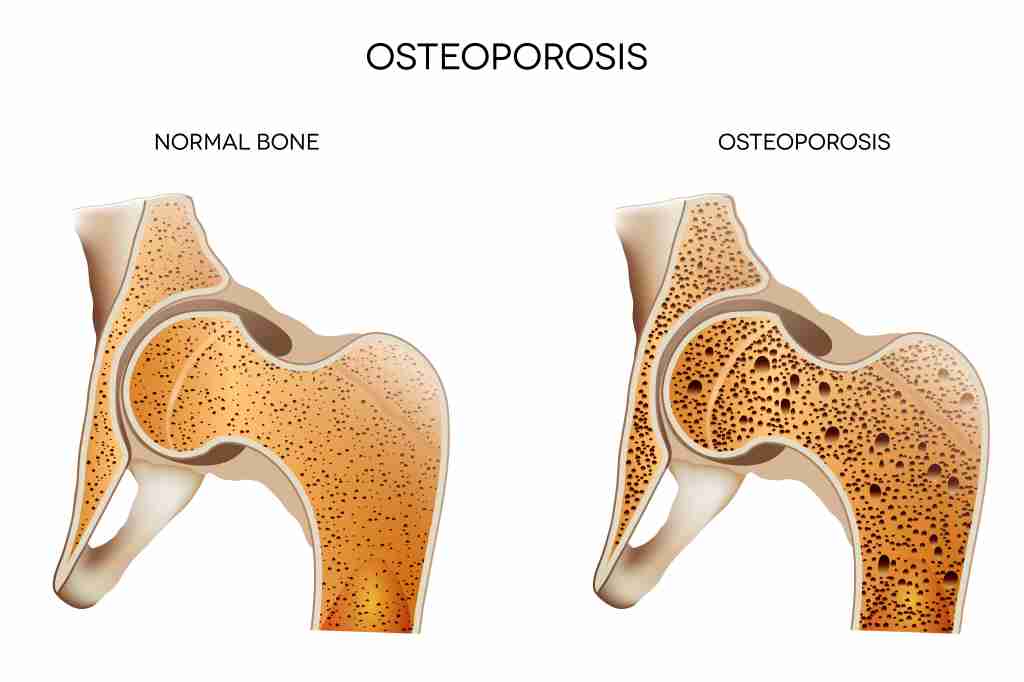 Kenali Osteoporosis Sejak Dini